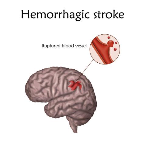 Diagrama del accidente cerebrovascular (ACV) hemorrágico
